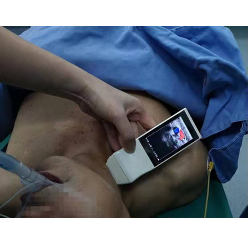 WIFI 무선 컬러 프로브 부인과 초음파 선형 프로브 디스플레이 마취 천자 내비게이션 휴대용 초음파
